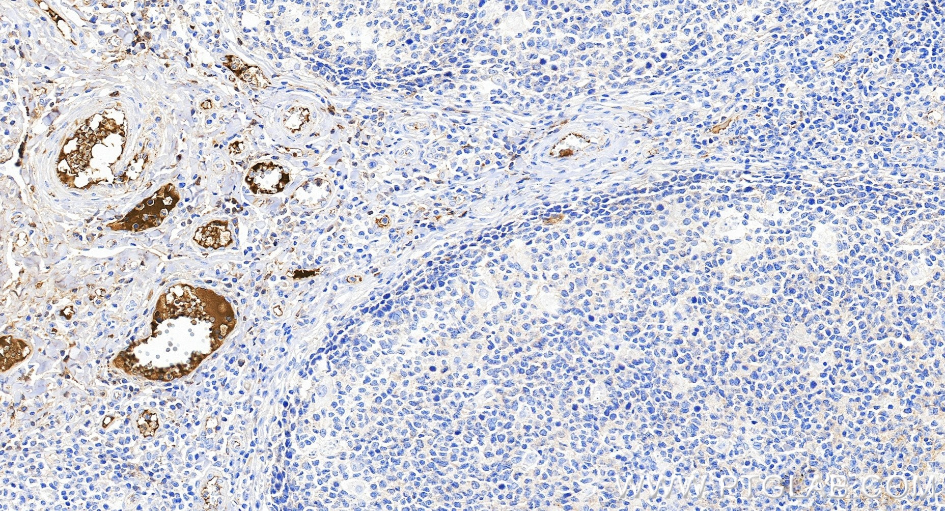 Immunohistochemistry (IHC) staining of human tonsillitis tissue using C9 Recombinant monoclonal antibody (84890-4-RR)