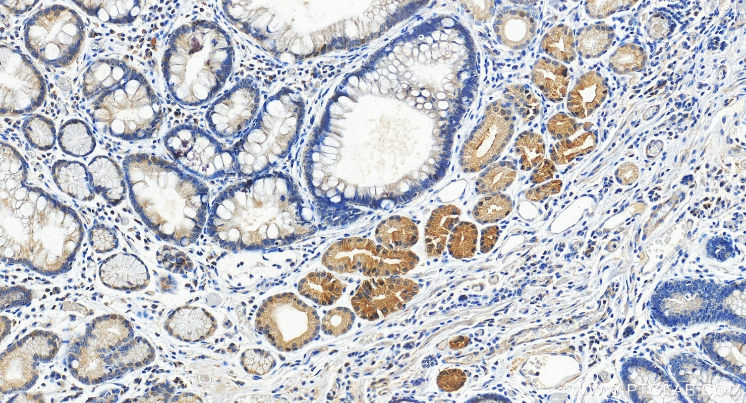 Immunohistochemistry (IHC) staining of human stomach cancer tissue using ERCC6L2 Polyclonal antibody (27028-1-AP)