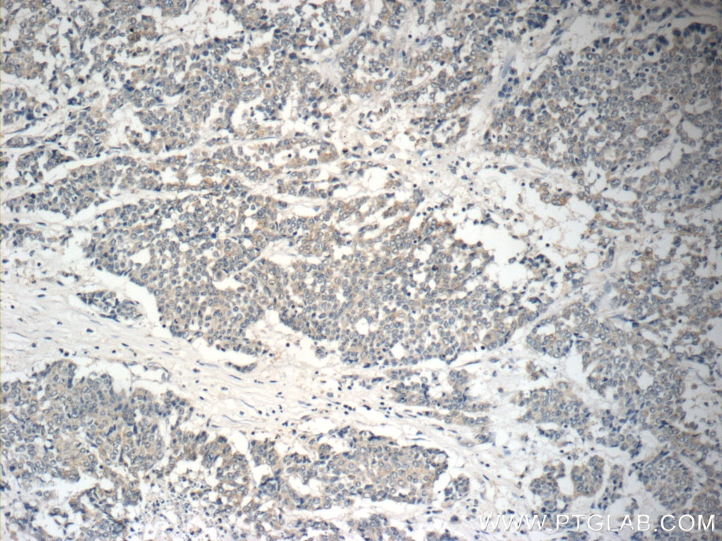 Immunohistochemistry (IHC) staining of human colon cancer tissue using NGX6 Polyclonal antibody (21593-1-AP)
