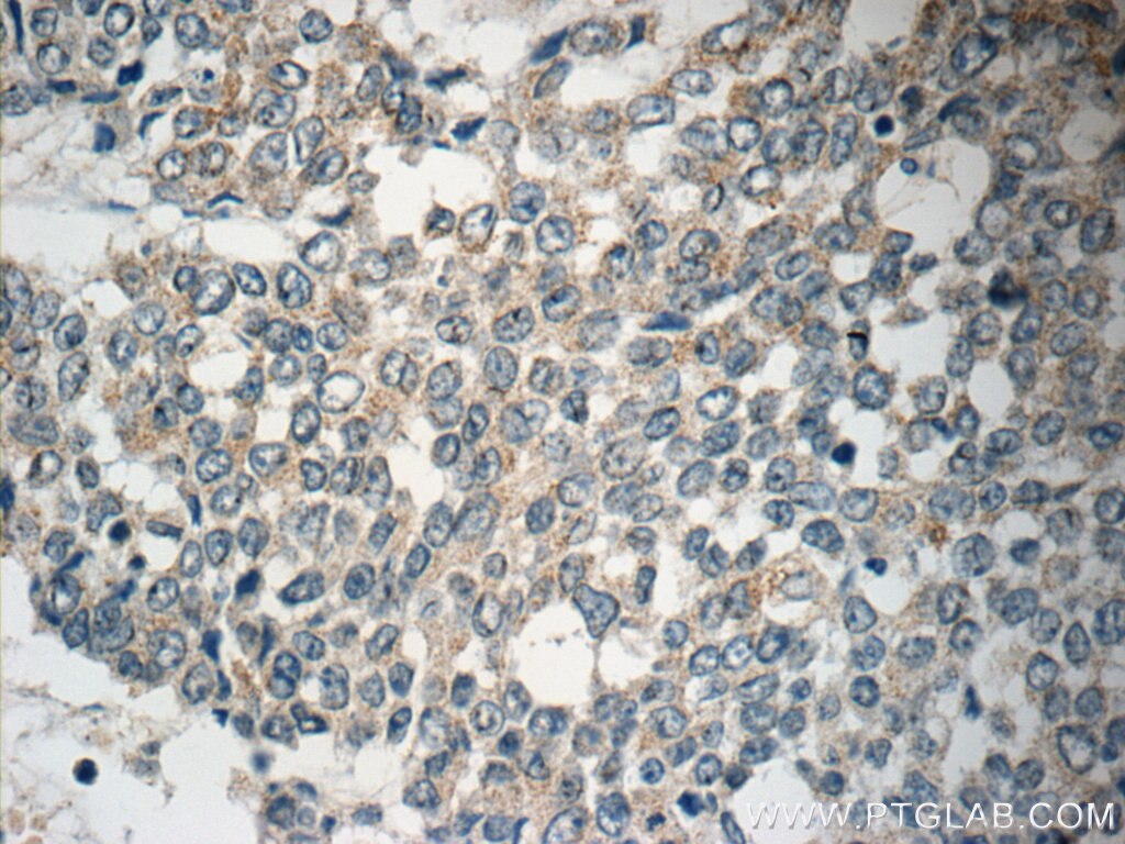 Immunohistochemistry (IHC) staining of human colon cancer tissue using NGX6 Polyclonal antibody (21593-1-AP)
