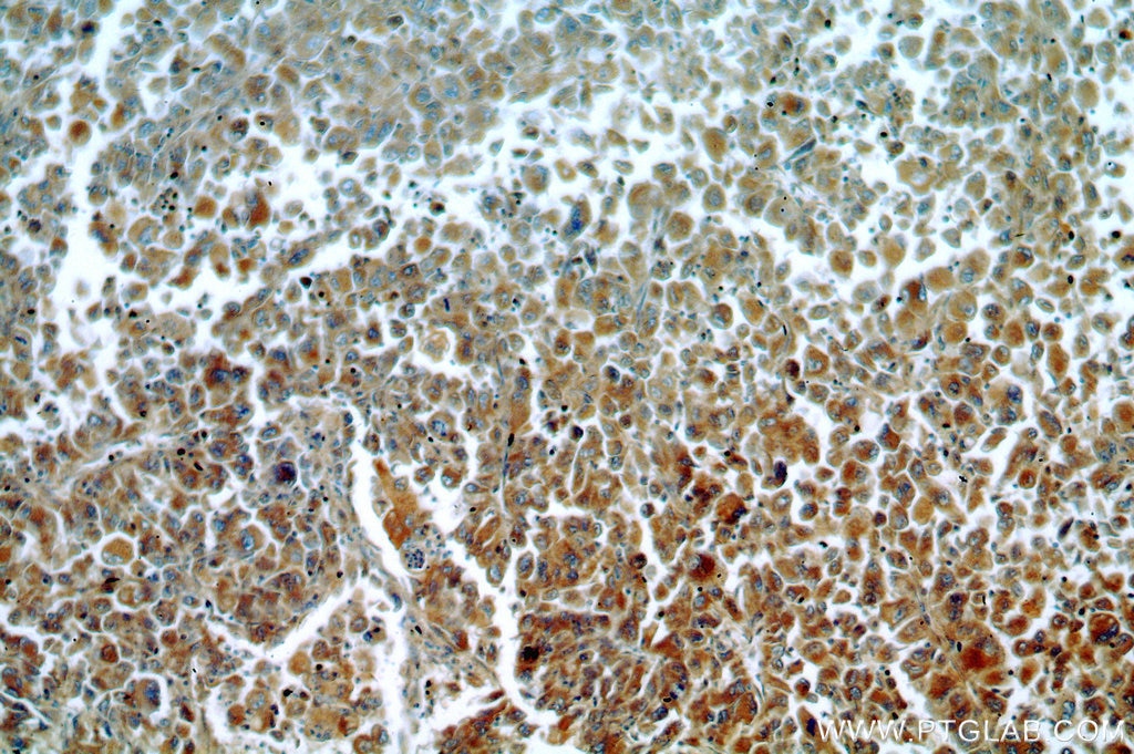 Immunohistochemistry (IHC) staining of human lung cancer tissue using C9orf156 Polyclonal antibody (20475-1-AP)