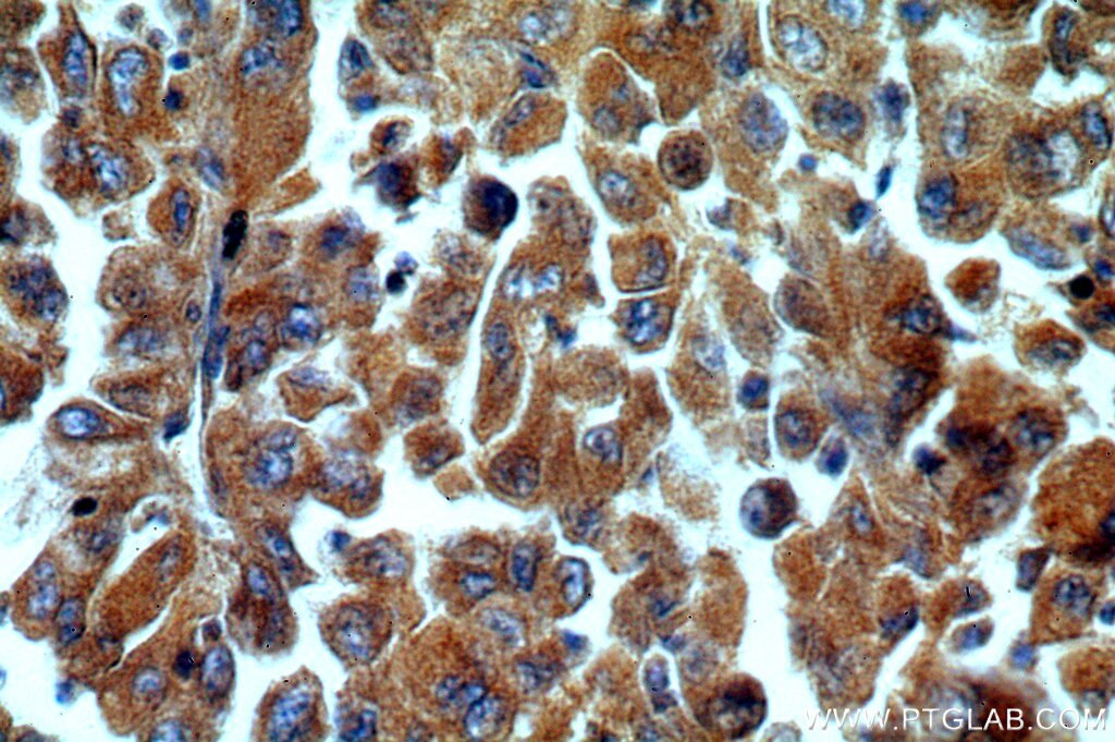 Immunohistochemistry (IHC) staining of human lung cancer tissue using C9orf156 Polyclonal antibody (20475-1-AP)