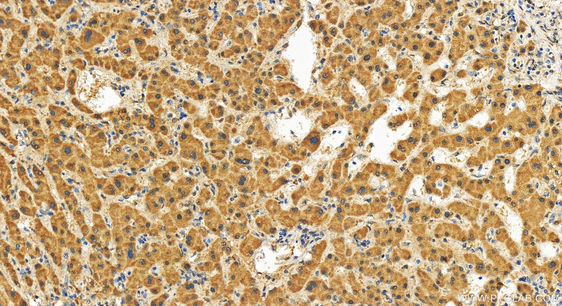 Immunohistochemistry (IHC) staining of human intrahepatic cholangiocarcinoma tissue using C9orf64 Polyclonal antibody (27797-1-AP)