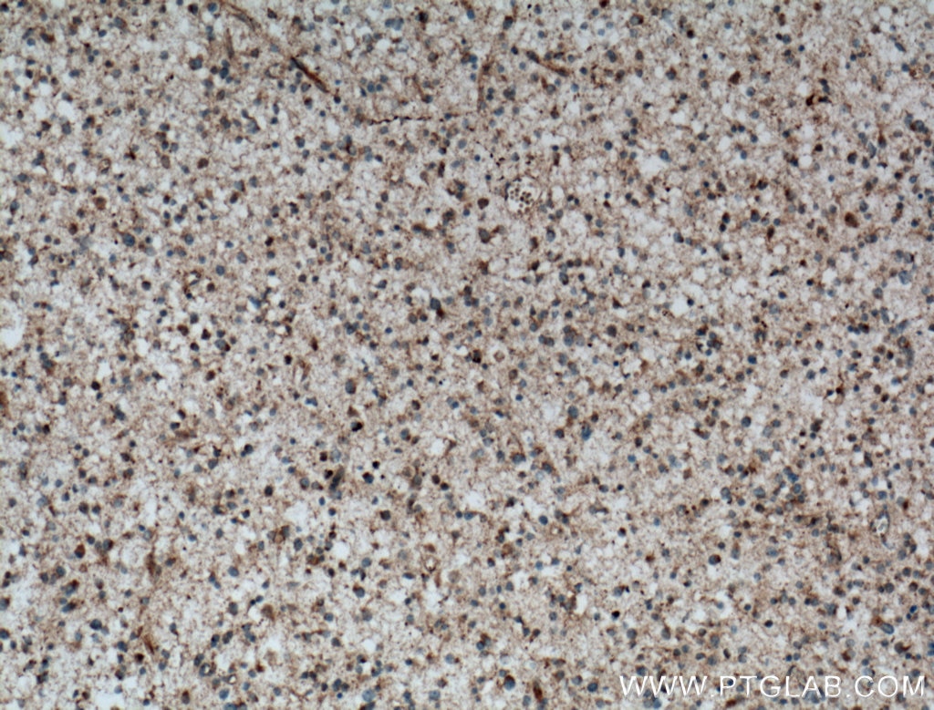 Immunohistochemistry (IHC) staining of human gliomas tissue using C9orf72 Polyclonal antibody (22637-1-AP)