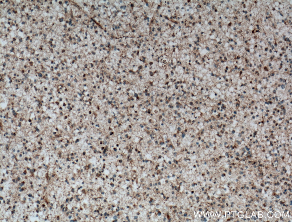 IHC staining of human gliomas using 22637-1-AP