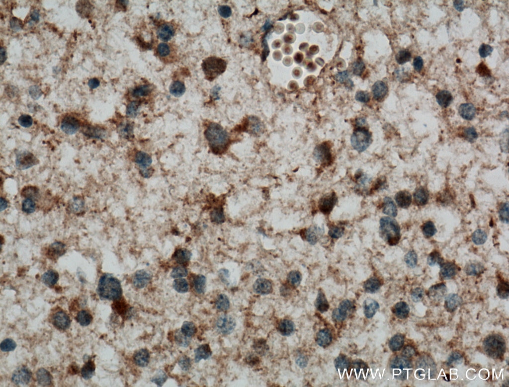 Immunohistochemistry (IHC) staining of human gliomas tissue using C9orf72 Polyclonal antibody (22637-1-AP)