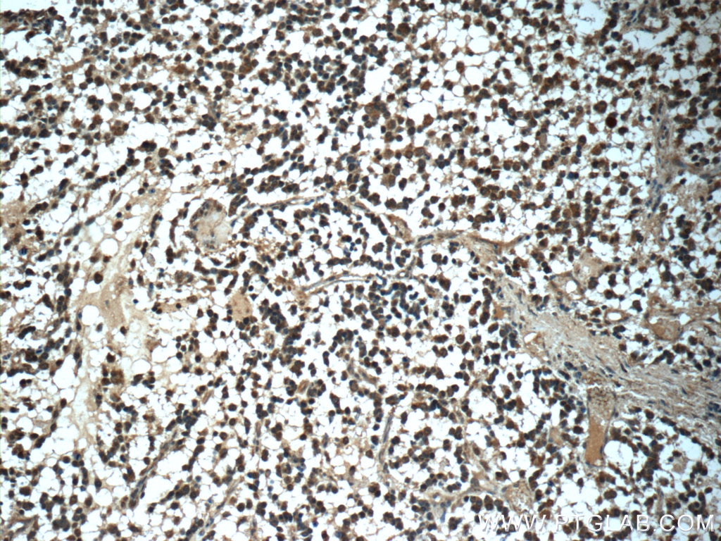 Immunohistochemistry (IHC) staining of human gliomas tissue using C9orf72 Polyclonal antibody (22637-1-AP)