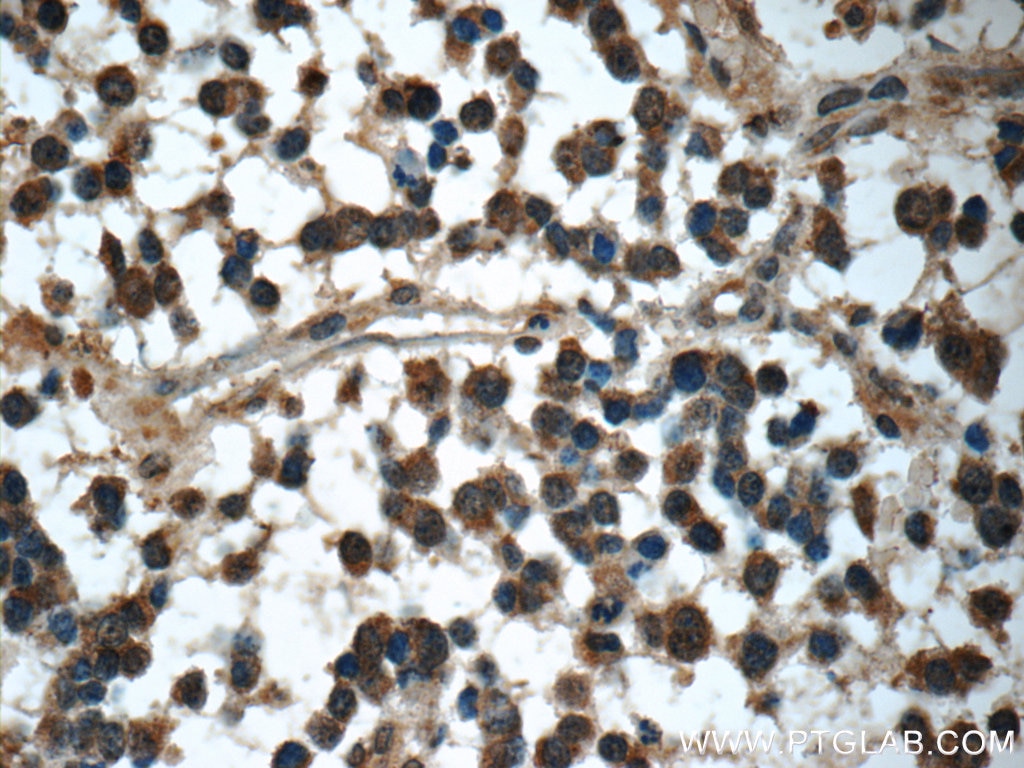 IHC staining of human gliomas using 22637-1-AP