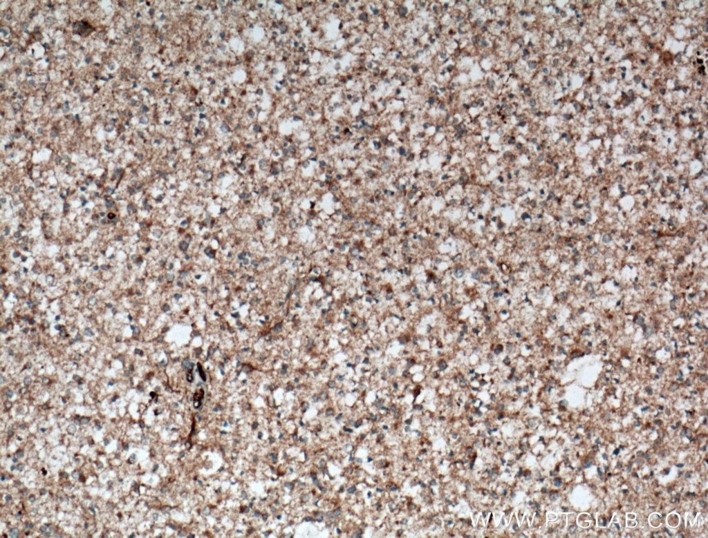 Immunohistochemistry (IHC) staining of human gliomas tissue using C9orf72 Polyclonal antibody (25757-1-AP)