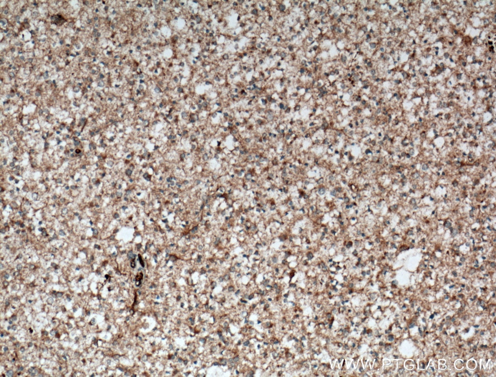 IHC staining of human gliomas using 25757-1-AP