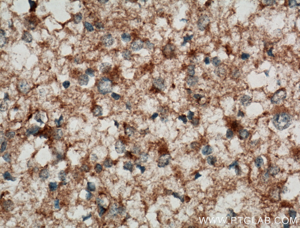 IHC staining of human gliomas using 25757-1-AP