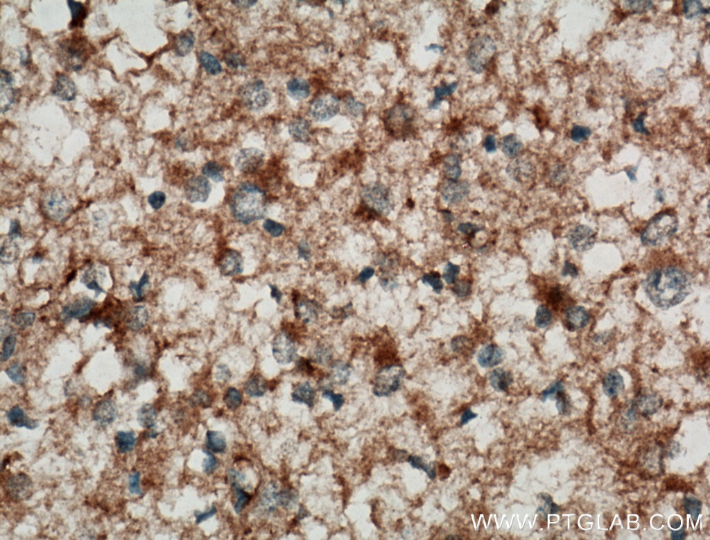 Immunohistochemistry (IHC) staining of human gliomas tissue using C9orf72 Polyclonal antibody (25757-1-AP)