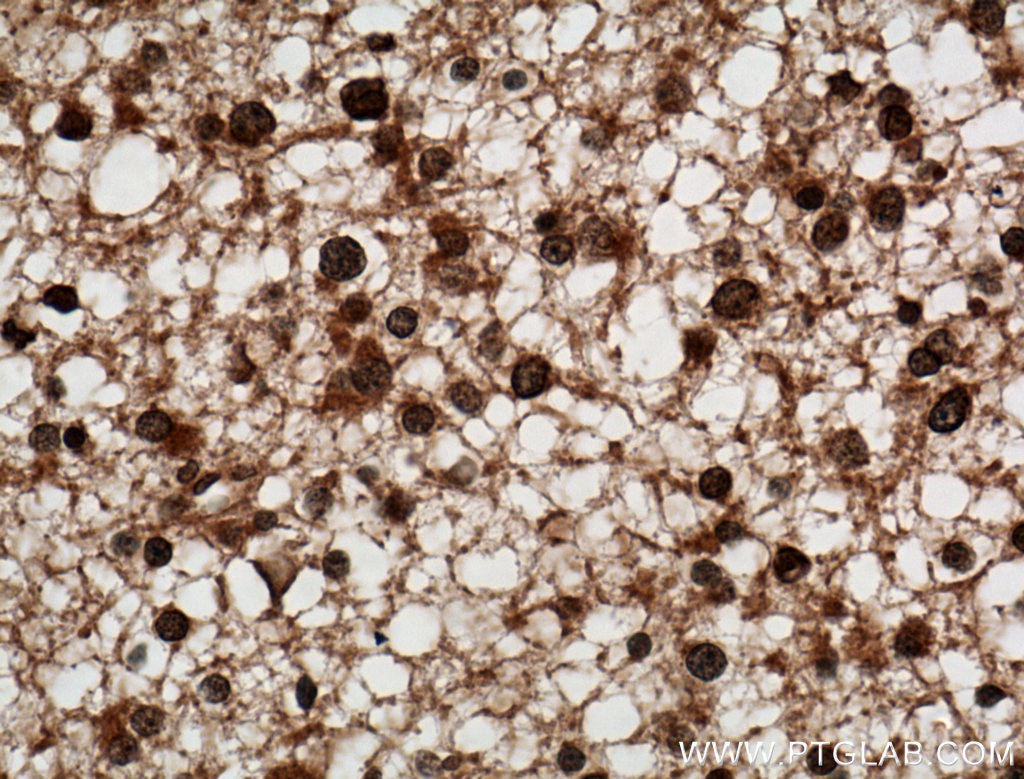 Immunohistochemistry (IHC) staining of human gliomas tissue using C9orf72 Monoclonal antibody (66140-1-Ig)