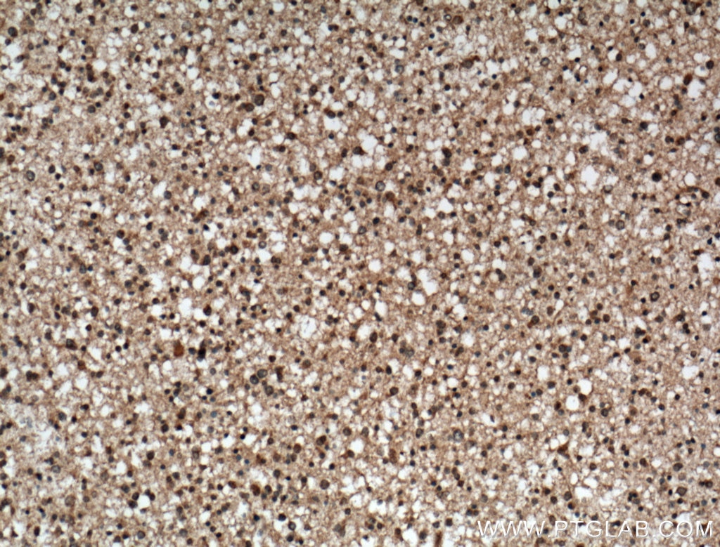 Immunohistochemistry (IHC) staining of human gliomas tissue using C9orf72 Monoclonal antibody (66140-1-Ig)