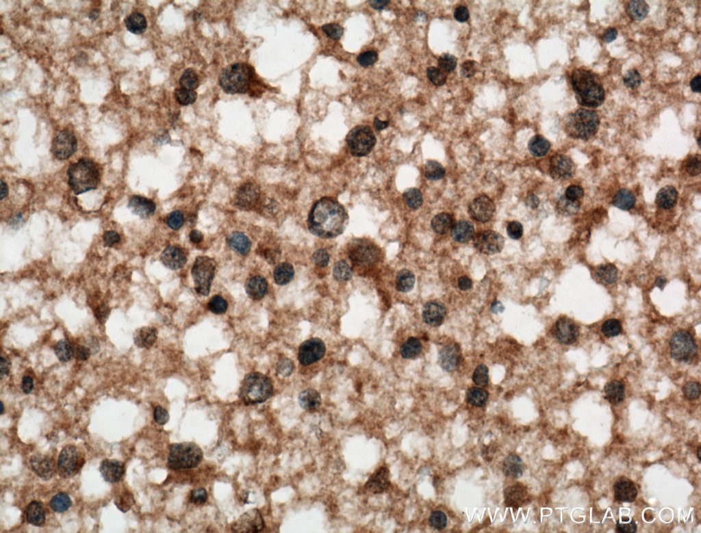 Immunohistochemistry (IHC) staining of human gliomas tissue using C9orf72 Monoclonal antibody (66140-1-Ig)