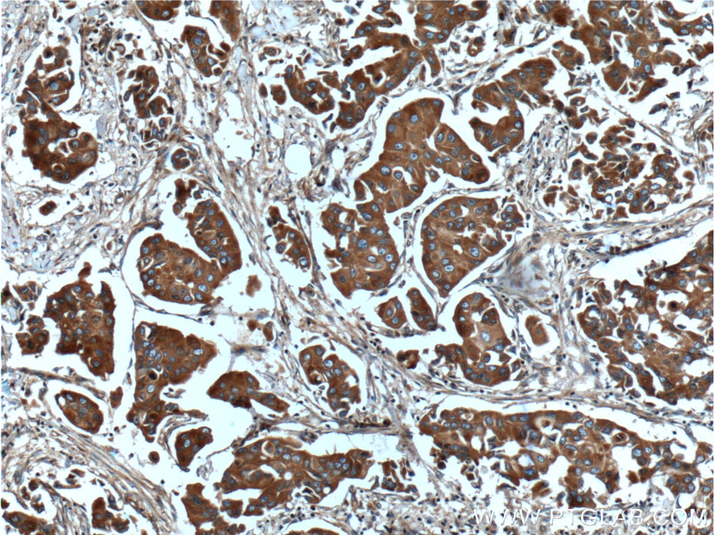 Immunohistochemistry (IHC) staining of human breast cancer tissue using C9orf86 Polyclonal antibody (20848-1-AP)