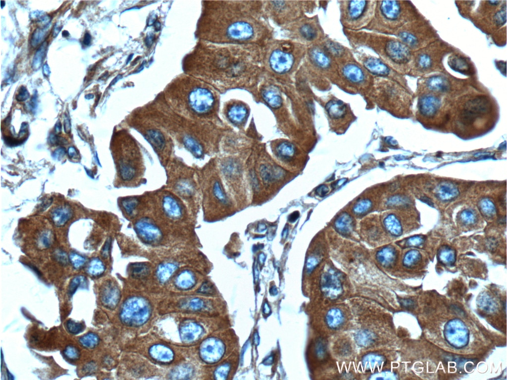 Immunohistochemistry (IHC) staining of human breast cancer tissue using C9orf86 Polyclonal antibody (20848-1-AP)