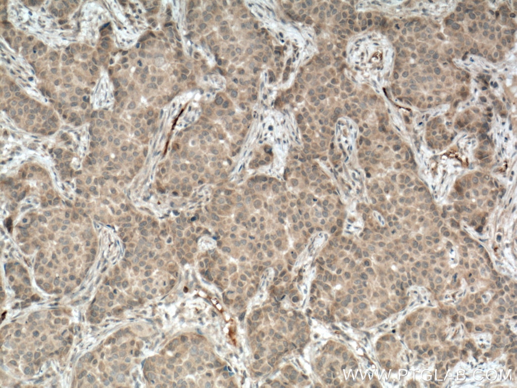 Immunohistochemistry (IHC) staining of human breast cancer tissue using CA1 Polyclonal antibody (13198-2-AP)