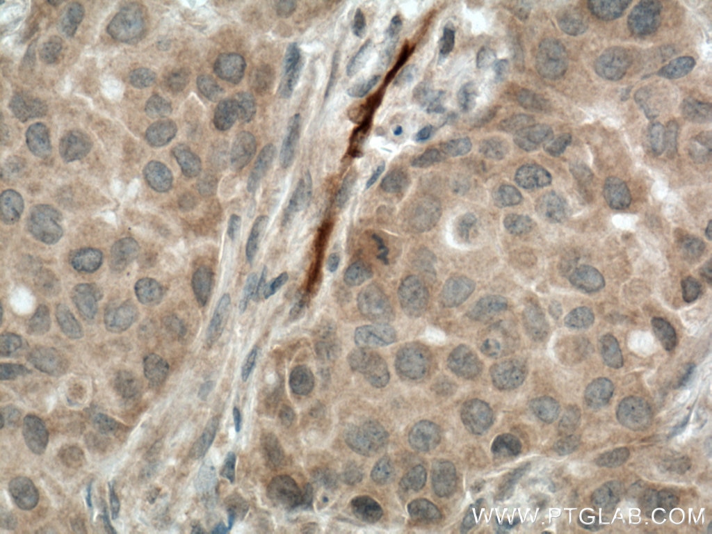 Immunohistochemistry (IHC) staining of human breast cancer tissue using CA1 Polyclonal antibody (13198-2-AP)