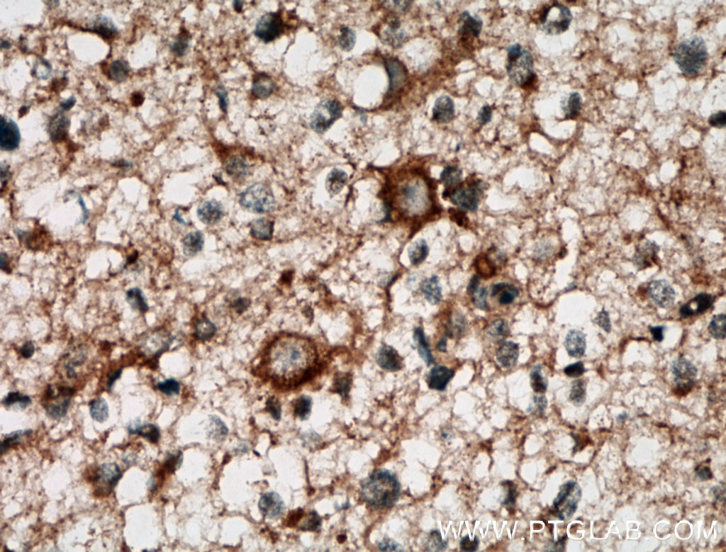 Immunohistochemistry (IHC) staining of human gliomas tissue using CA10 Polyclonal antibody (12953-1-AP)