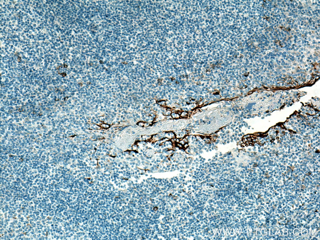 Immunohistochemistry (IHC) staining of human tonsillitis tissue using MUC1/CA15-3 C-terminal Polyclonal antibody (23614-1-AP)