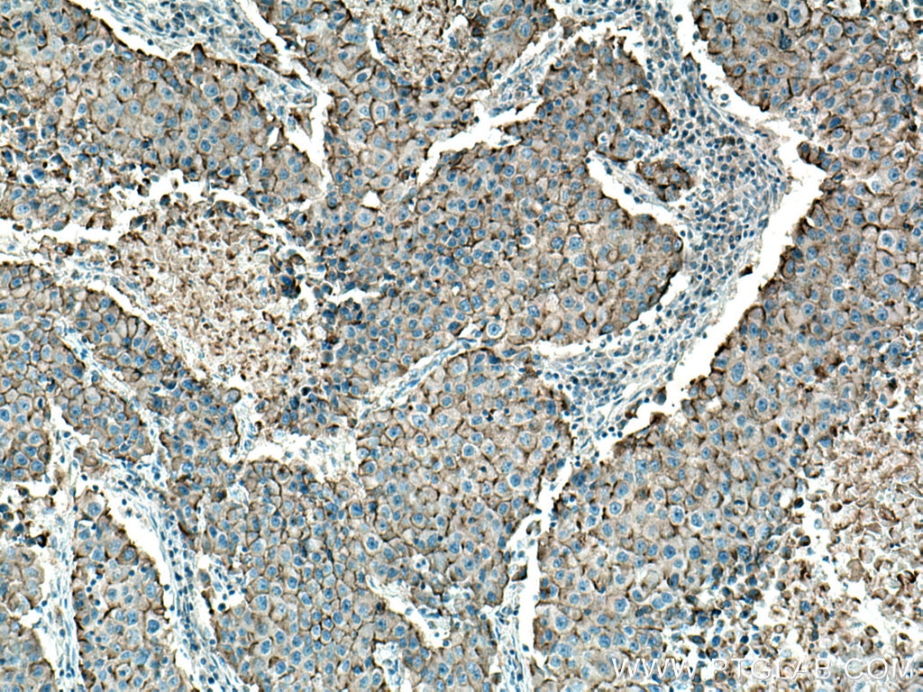 Immunohistochemistry (IHC) staining of human breast cancer tissue using MUC1/CA15-3 C-terminal Polyclonal antibody (23614-1-AP)