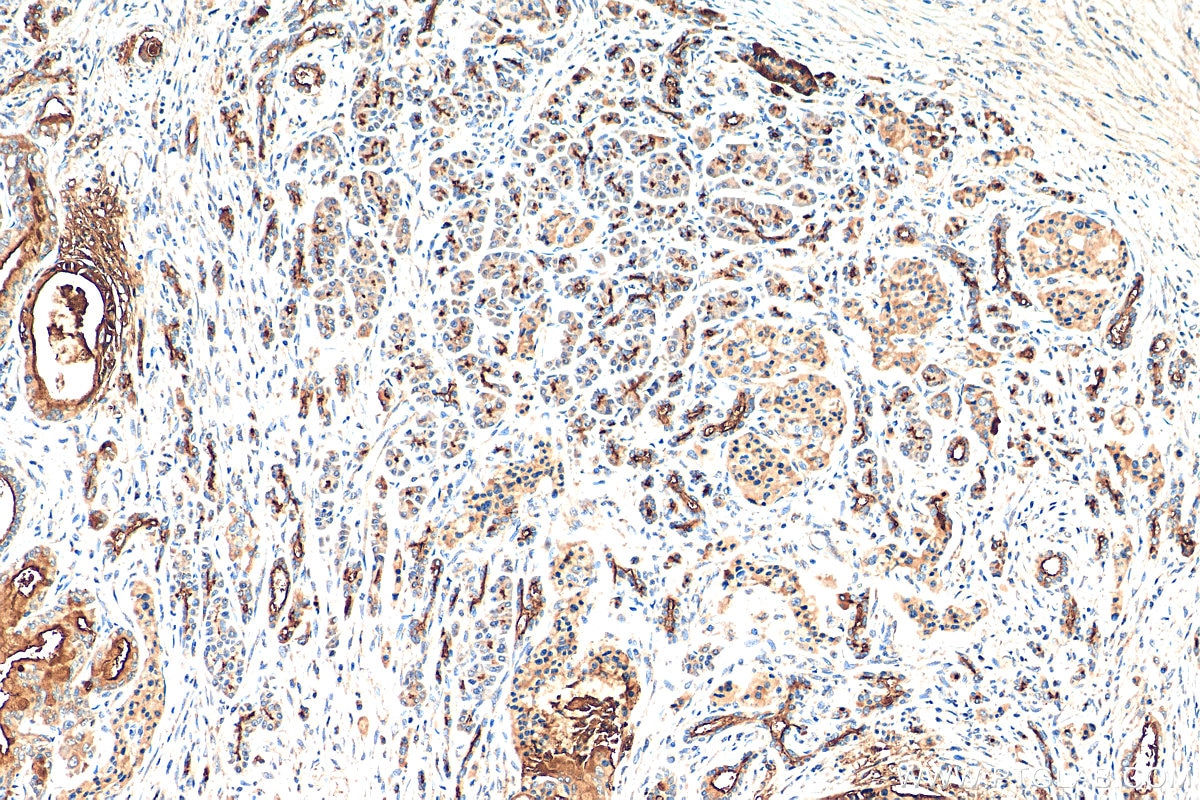 Immunohistochemistry (IHC) staining of human pancreas cancer tissue using MUC1/CA15-3 C-terminal Polyclonal antibody (23614-1-AP)