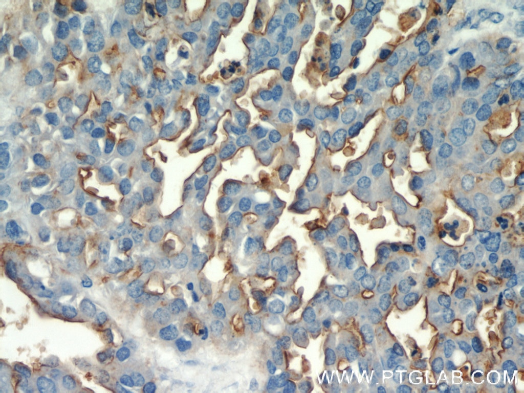 Immunohistochemistry (IHC) staining of human ovary tumor tissue using MUC1/CA15-3 C-terminal Polyclonal antibody (23614-1-AP)
