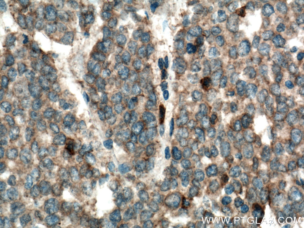 IHC staining of human colon cancer using 13931-1-AP