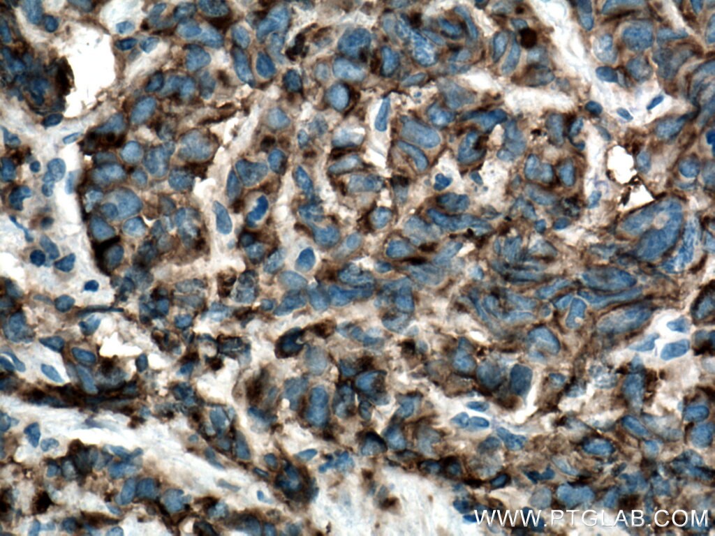 IHC staining of human prostate cancer using 13931-1-AP