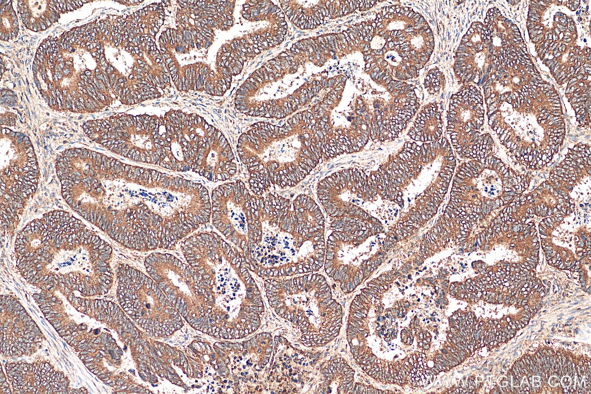Immunohistochemistry (IHC) staining of human colon cancer tissue using CA4 Polyclonal antibody (13931-1-AP)