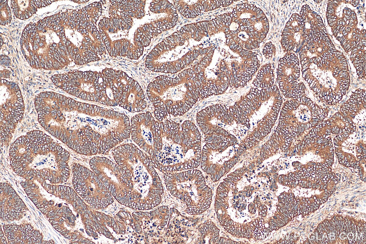 IHC staining of human colon cancer using 13931-1-AP