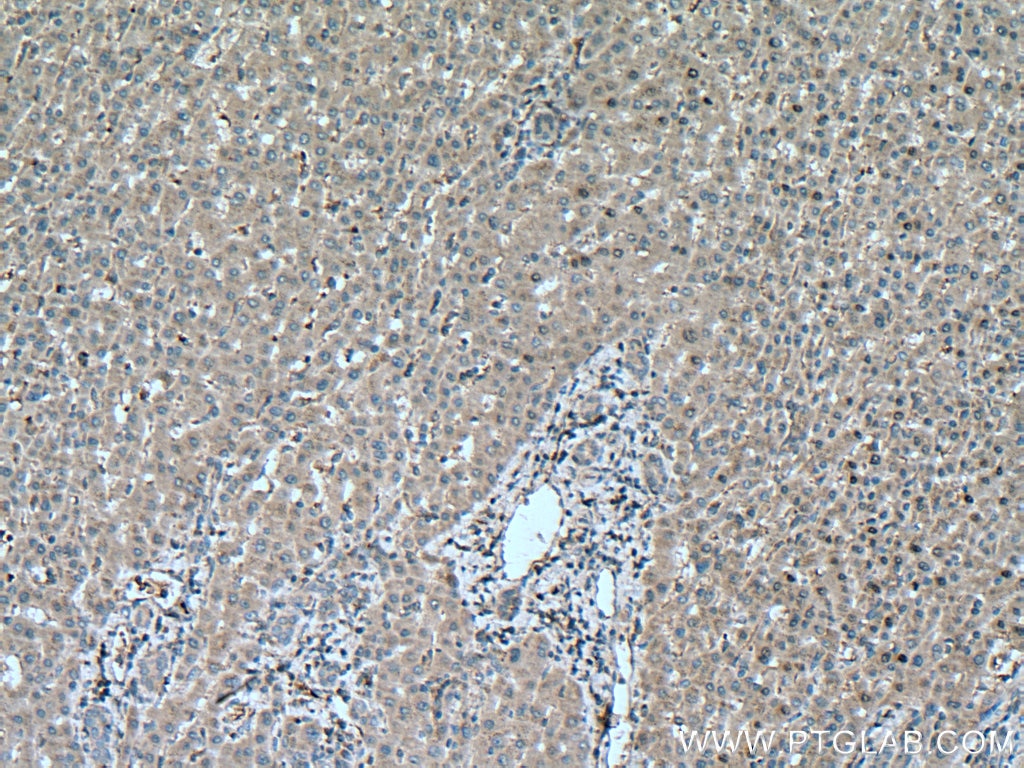 IHC staining of human liver cancer using 13670-1-AP