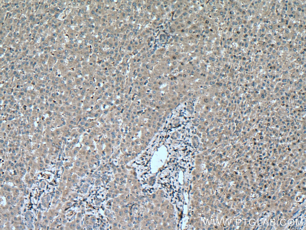 Immunohistochemistry (IHC) staining of human liver cancer tissue using CA7 Polyclonal antibody (13670-1-AP)