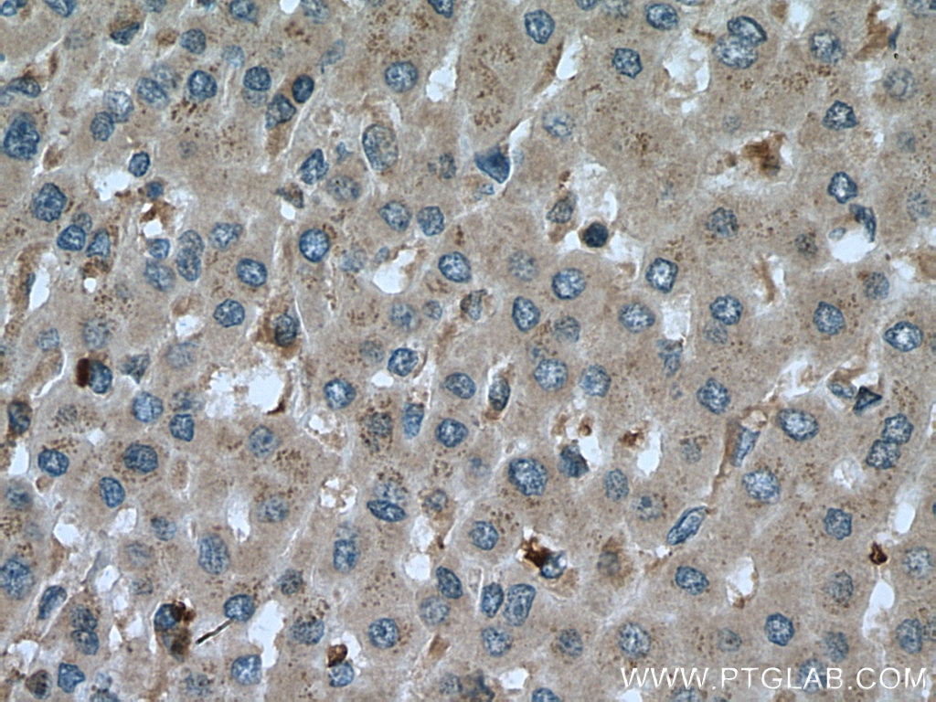 Immunohistochemistry (IHC) staining of human liver cancer tissue using CA7 Polyclonal antibody (13670-1-AP)