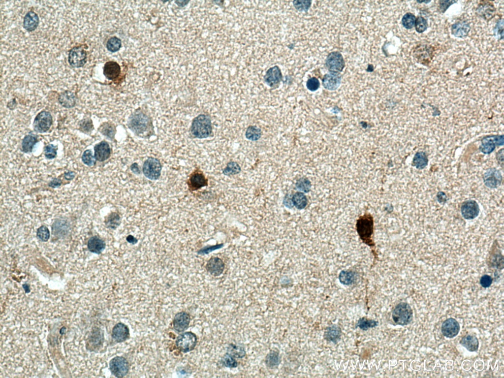 Immunohistochemistry (IHC) staining of human gliomas tissue using CA8 Polyclonal antibody (12391-1-AP)