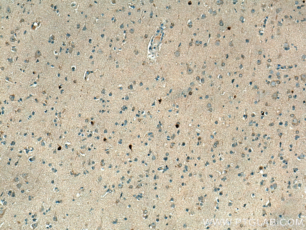 Immunohistochemistry (IHC) staining of human gliomas tissue using CA8 Polyclonal antibody (12391-1-AP)