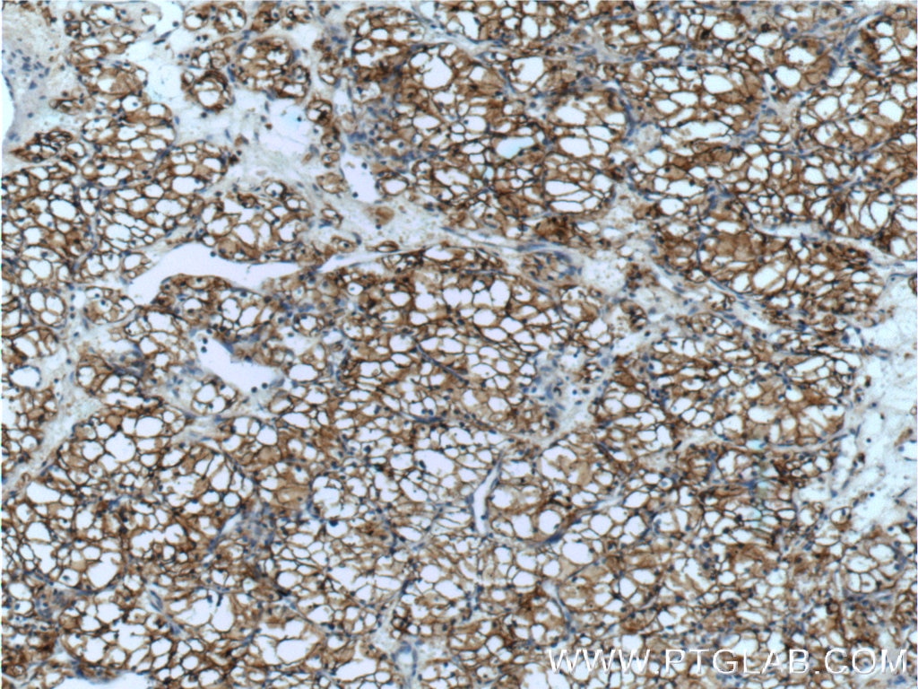 Immunohistochemistry (IHC) staining of human renal cell carcinoma tissue using CA9 Polyclonal antibody (11071-1-AP)