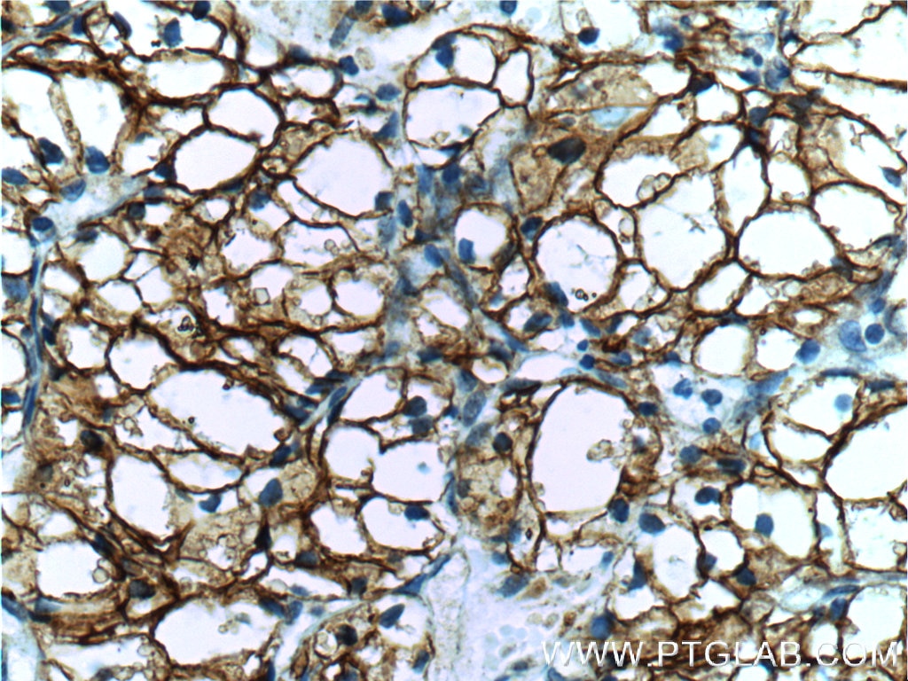 IHC staining of human renal cell carcinoma using 11071-1-AP