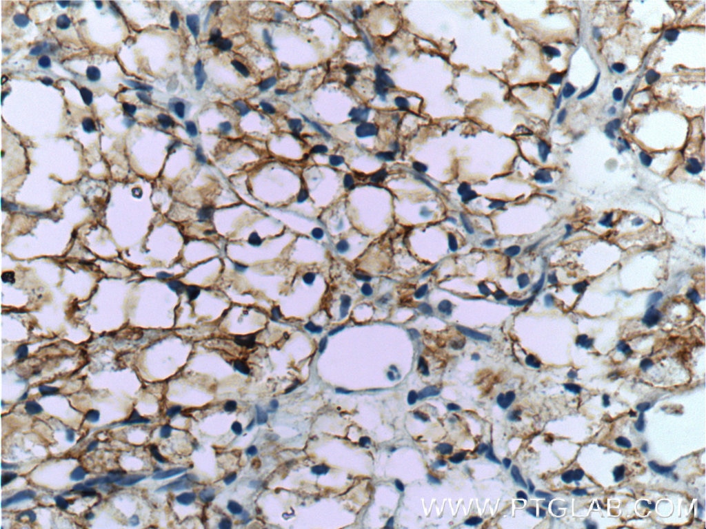 Immunohistochemistry (IHC) staining of human renal cell carcinoma tissue using CA9 Polyclonal antibody (11071-1-AP)