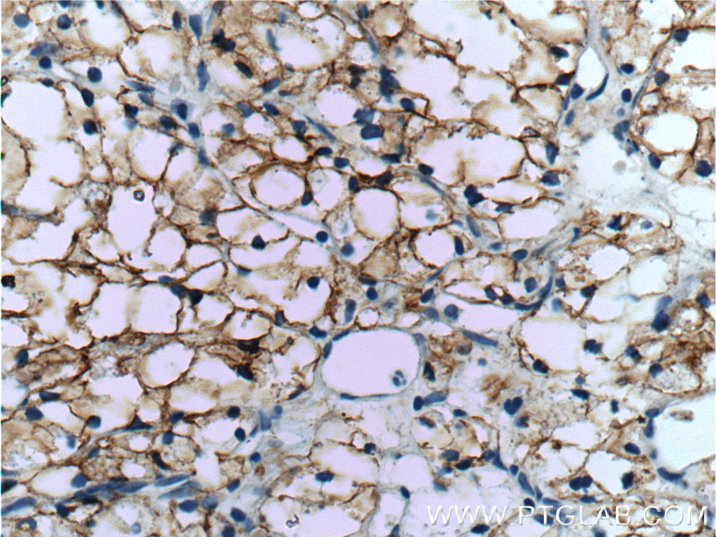 IHC staining of human renal cell carcinoma using 11071-1-AP