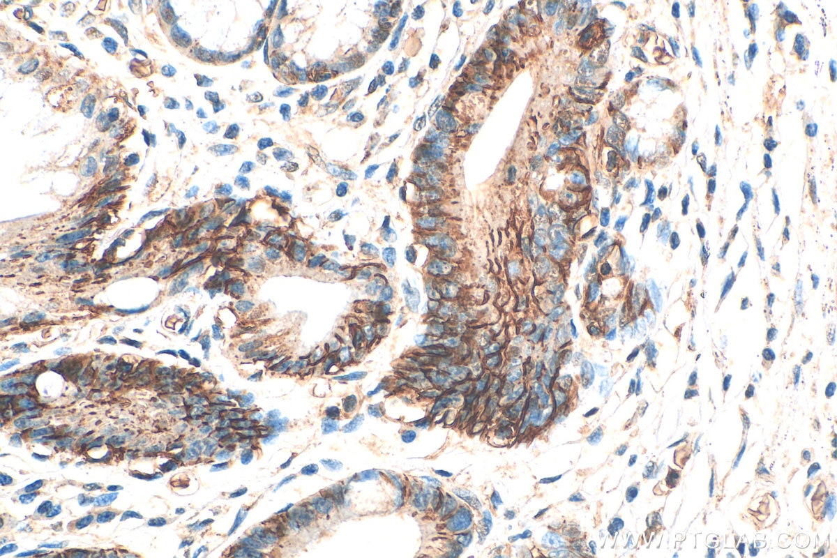 Immunohistochemistry (IHC) staining of human stomach cancer tissue using Carbonic Anhydrase IX/CA9 Polyclonal antibody (11071-1-AP)