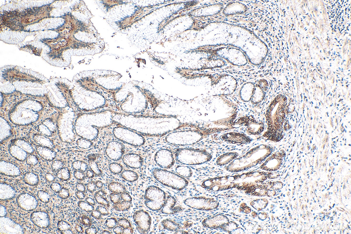 Immunohistochemistry (IHC) staining of human stomach cancer tissue using Carbonic Anhydrase IX/CA9 Polyclonal antibody (11071-1-AP)