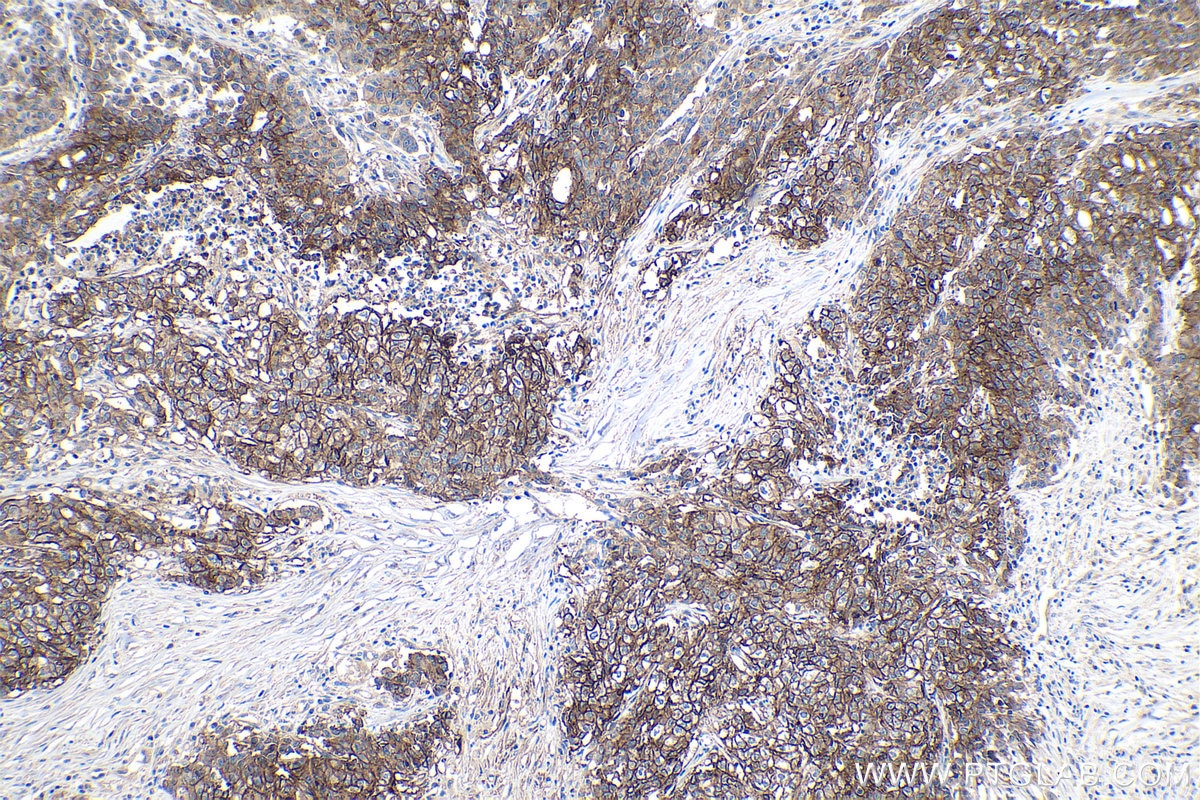 Immunohistochemistry (IHC) staining of human stomach cancer tissue using CA9 Polyclonal antibody (11443-1-AP)