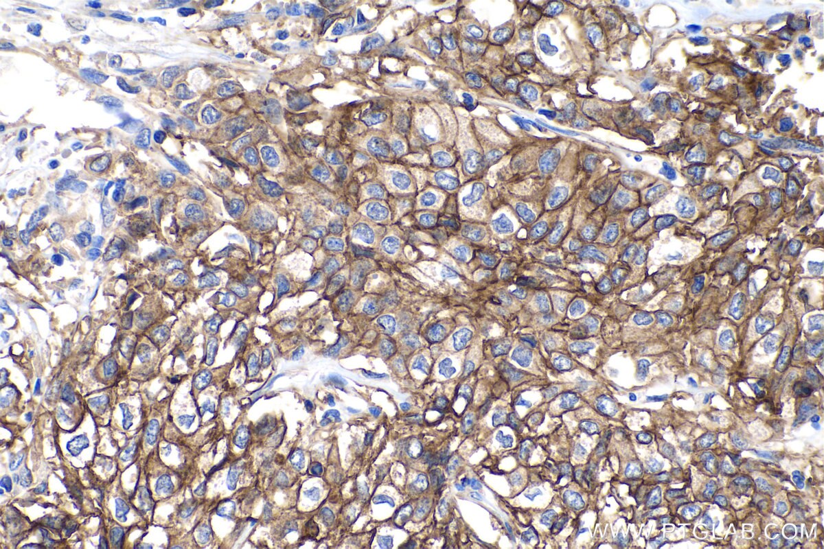 Immunohistochemistry (IHC) staining of human stomach cancer tissue using CA9 Polyclonal antibody (11443-1-AP)