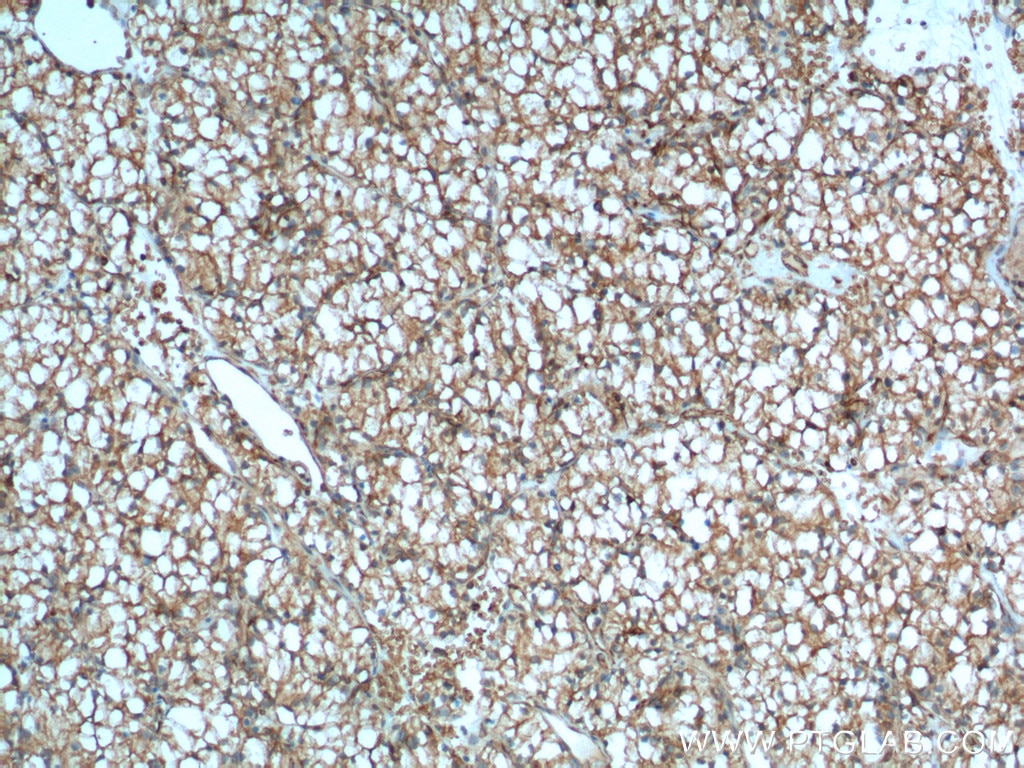 IHC staining of human renal cell carcinoma using 66243-1-Ig