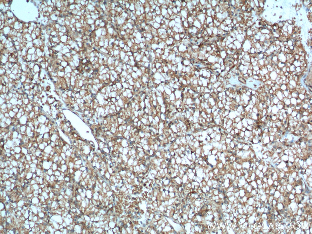 Immunohistochemistry (IHC) staining of human renal cell carcinoma tissue using CA9 Monoclonal antibody (66243-1-Ig)