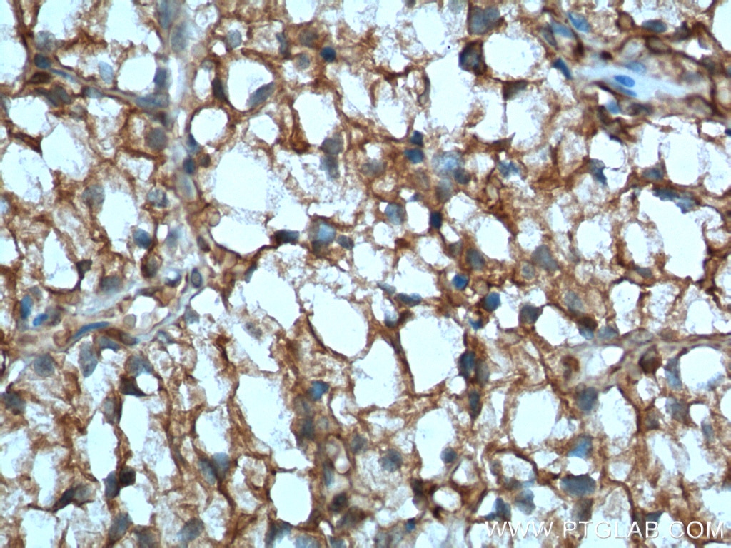 Immunohistochemistry (IHC) staining of human renal cell carcinoma tissue using CA9 Monoclonal antibody (66243-1-Ig)