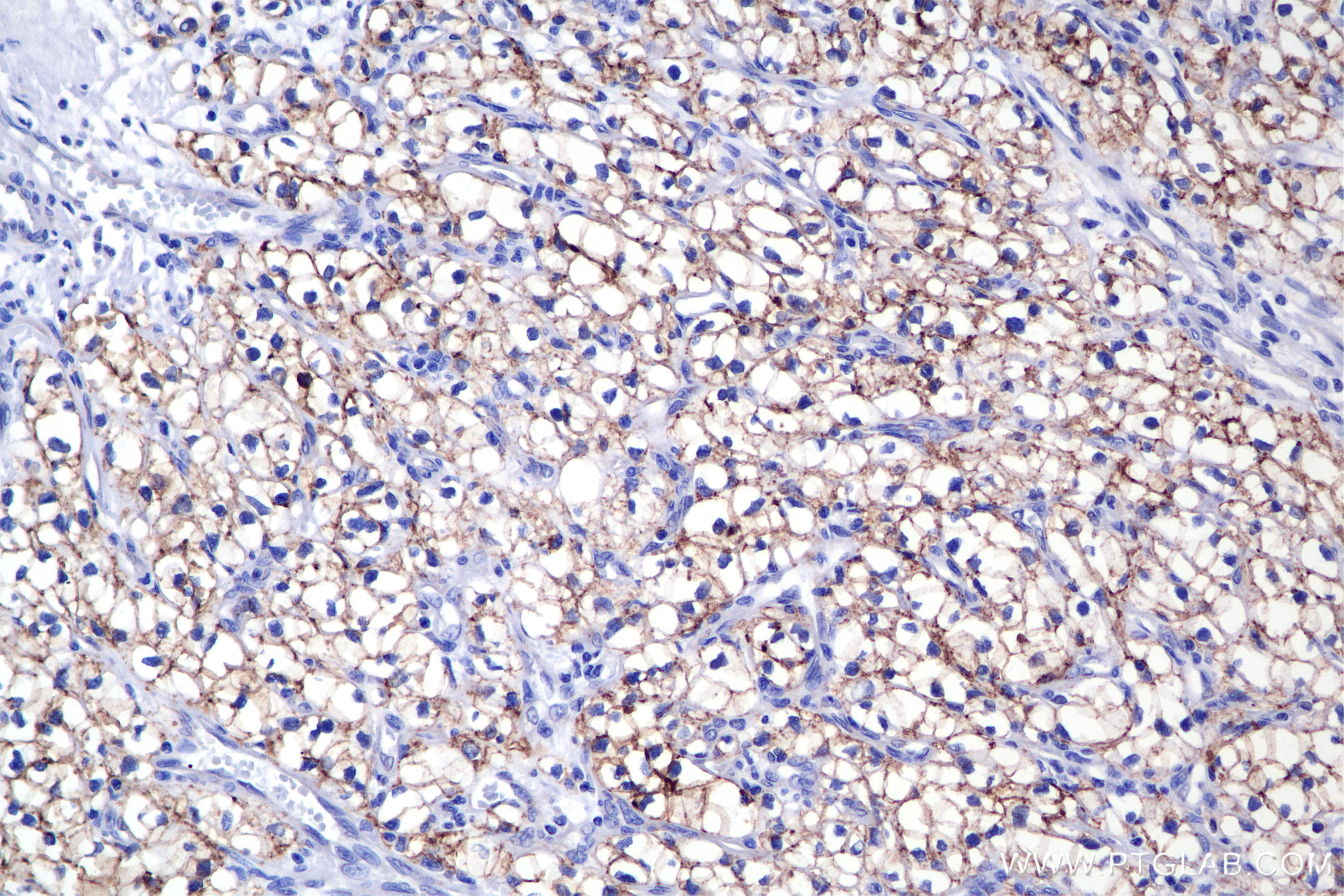 Immunohistochemistry (IHC) staining of Human Kidney(renal cell) Cancer using Carbonic Anhydrase IX/CA9 Recombinant monoclonal a (84233-1-RR)