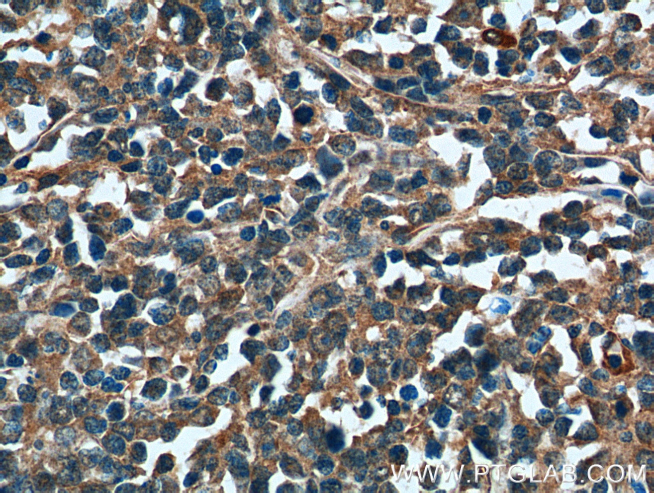 IHC staining of human lymphoma using 16137-1-AP
